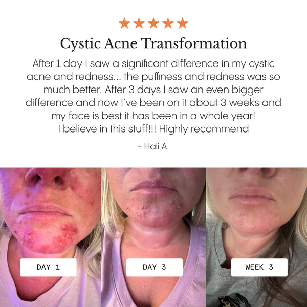 The Complete Acne System for Women