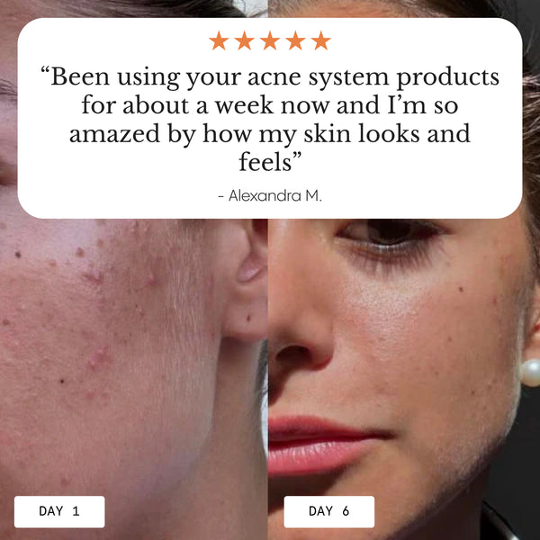 The Complete Acne System for Women