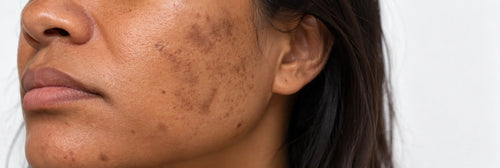 Dark Spots After 50? What No One Tells You About Fading Them