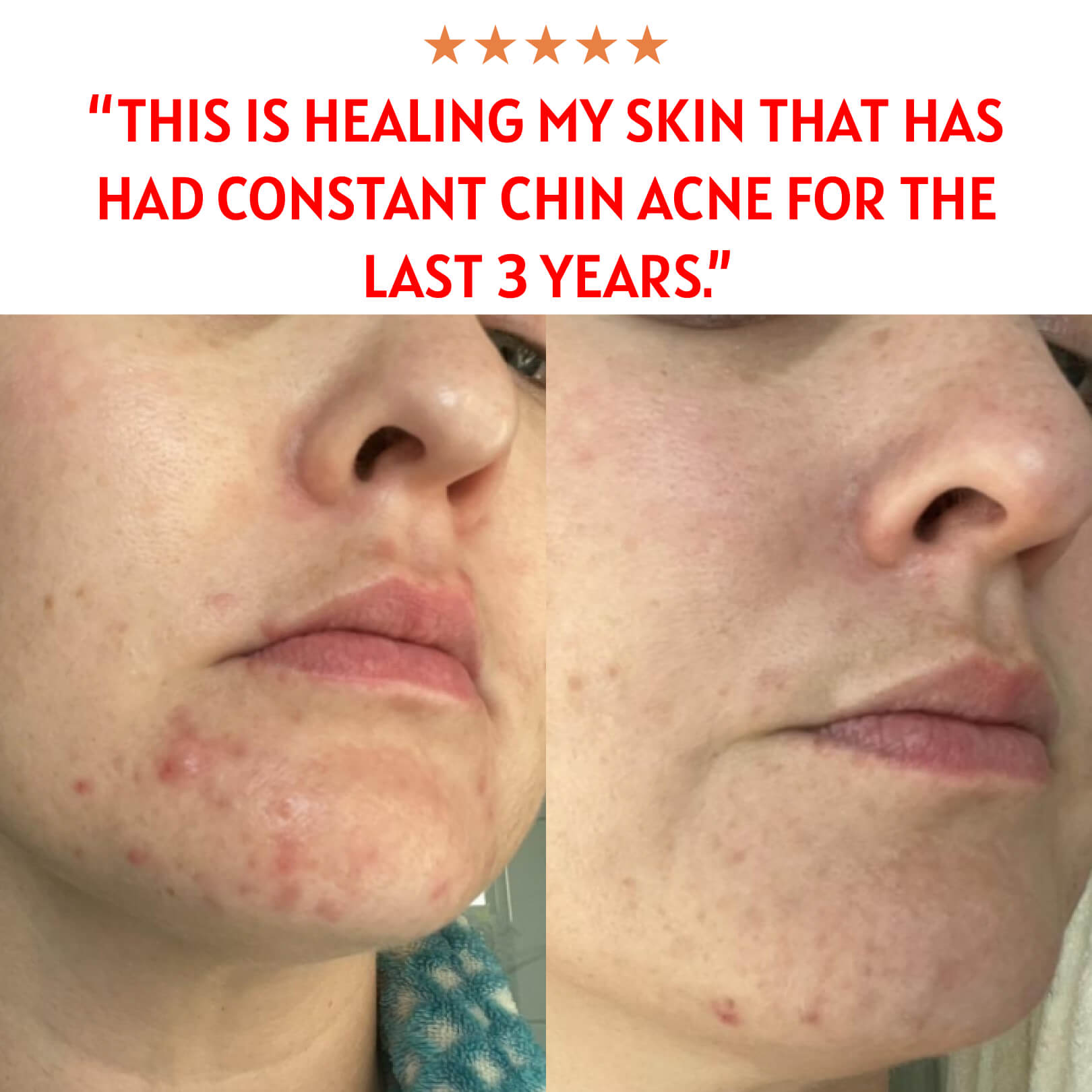 The Complete Acne System for Women