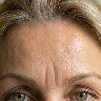 Forehead Lines & Frown Lines