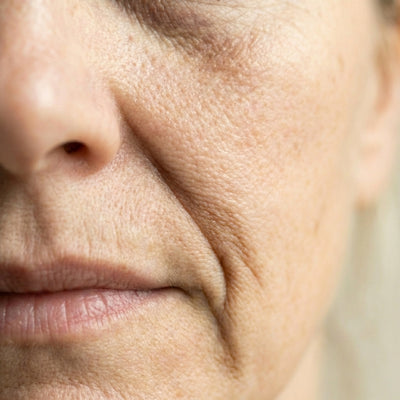 Nasolabial Folds (Smile Lines)