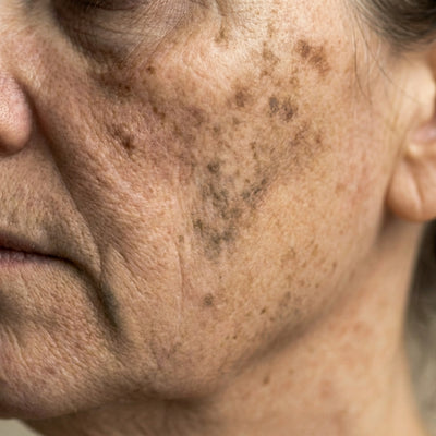 Uneven Skin Tone & Dark Spots