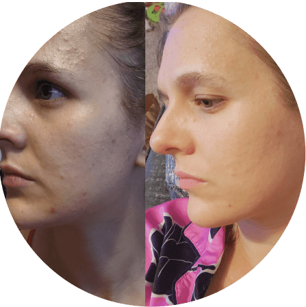 The Complete Acne System for Women | Frøya Organics