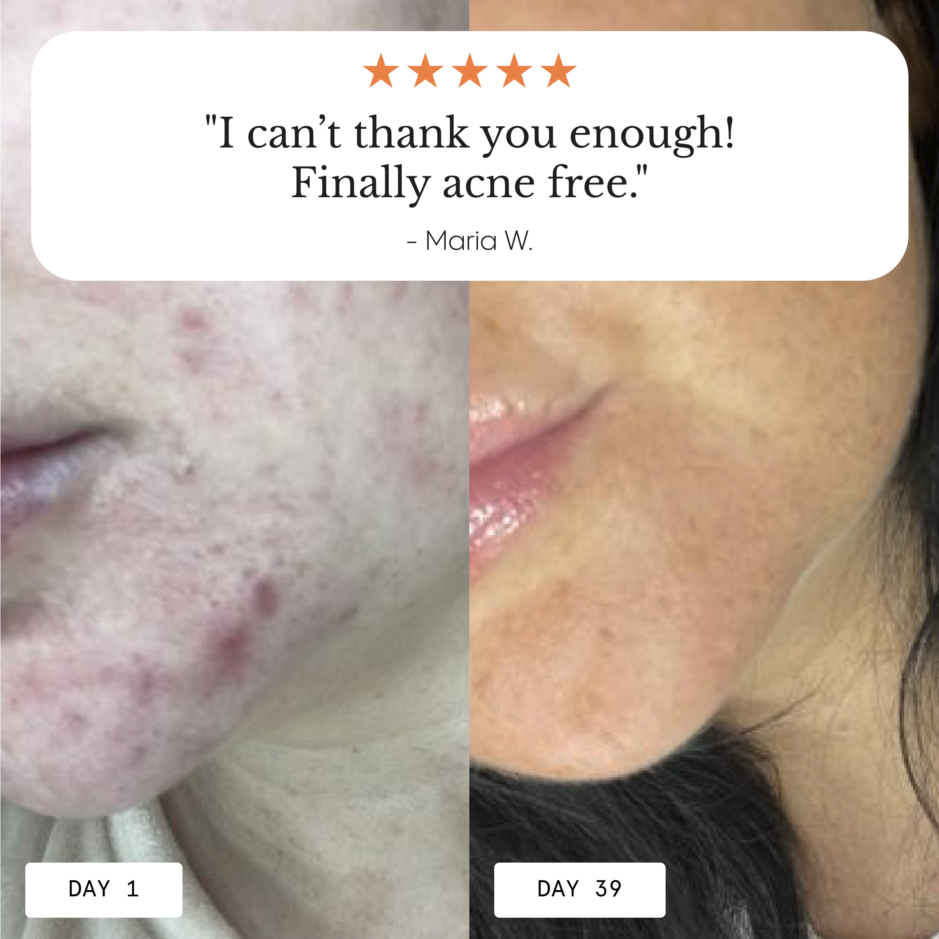 Instant Rosacea, Acne & Redness Stopper