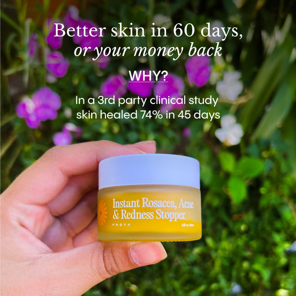 Customer testimonial and review of Frøya Organics Instant Rosacea, Acne & Redness Stopper