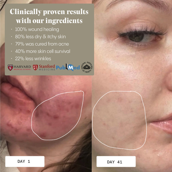 Frøya Organics Instant Rosacea, Acne & Redness Stopper compared to conventional skincare alternatives