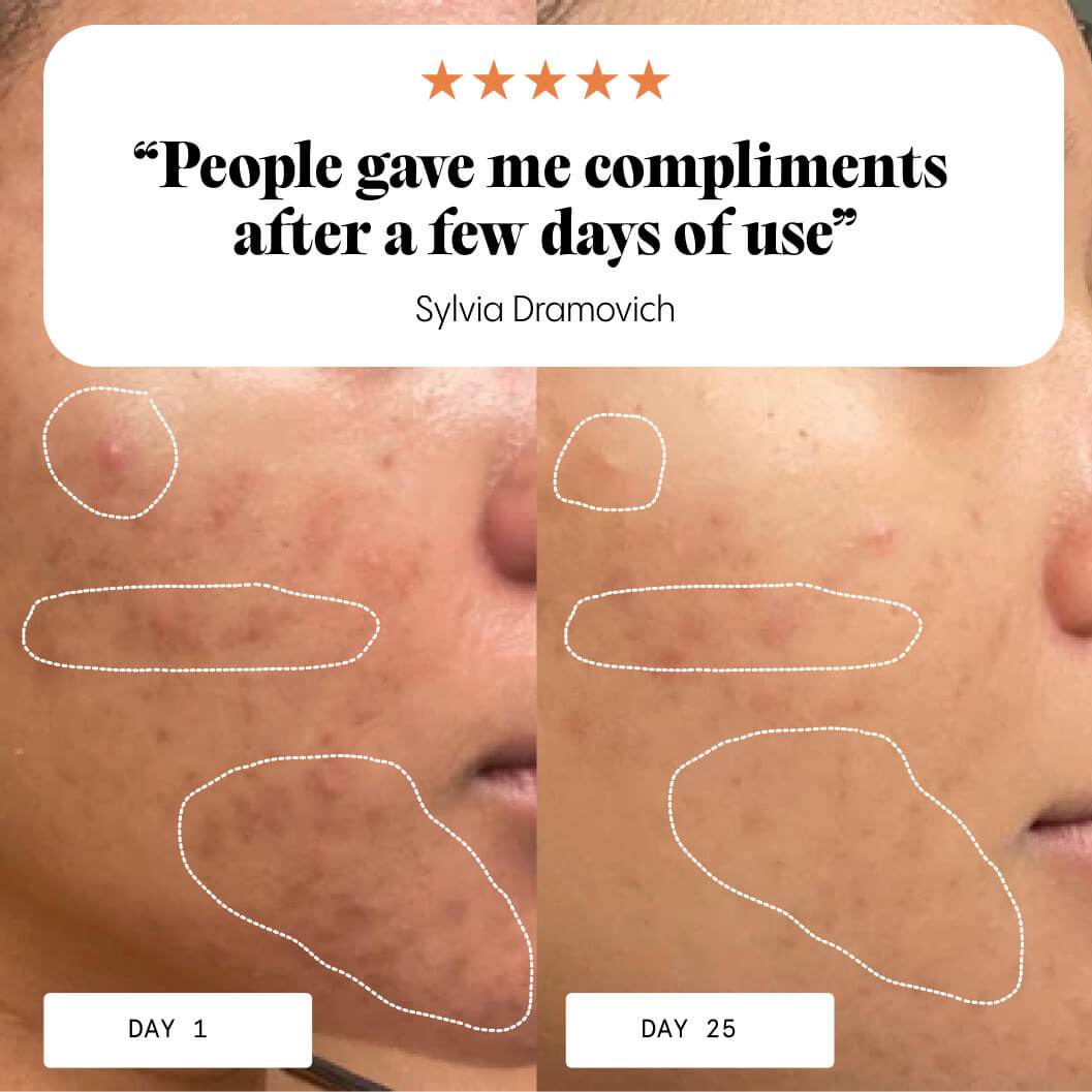 The Complete Acne System for Women