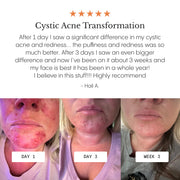 Frøya Organics Complete Acne System for Women open jar revealing concentrated 4-step acne system texture