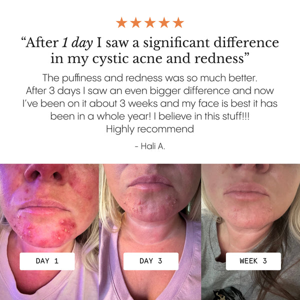 The Complete System for Acne-Prone Skin