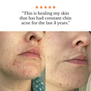 Système Complet pour Peau à Imperfections