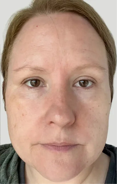 Trial participant 2 after 60 days