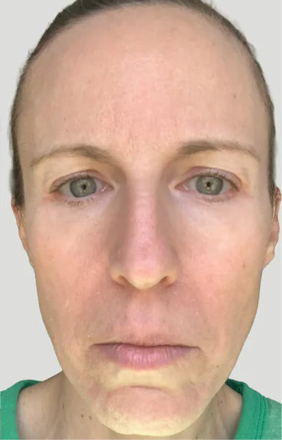 Trial participant 5 after 60 days