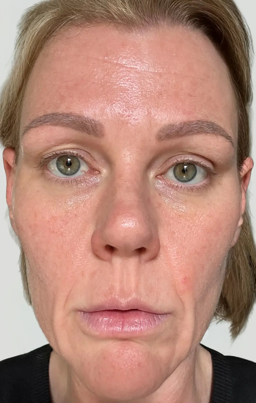 Clinical trial participant before, day 0